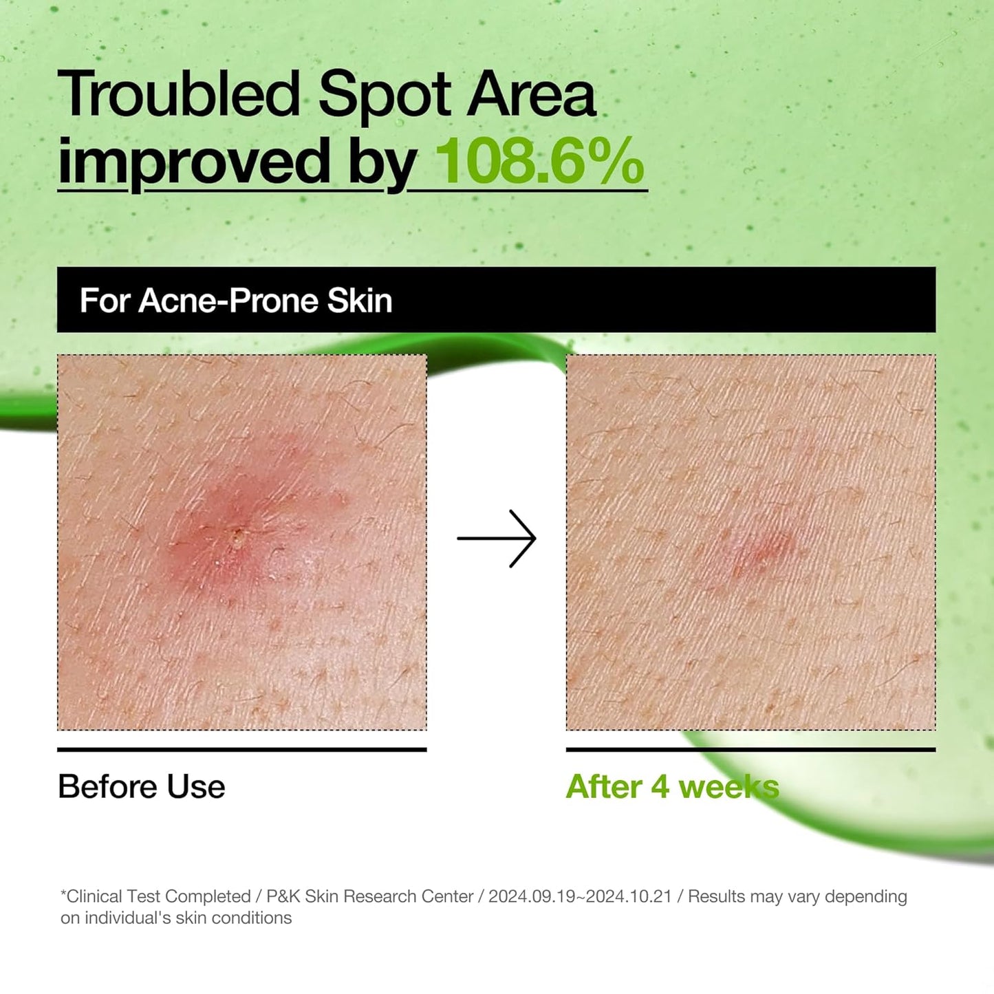 ANUA - Azelaic Acid 10 Hyaluron Redness Soothing Serum 30ml